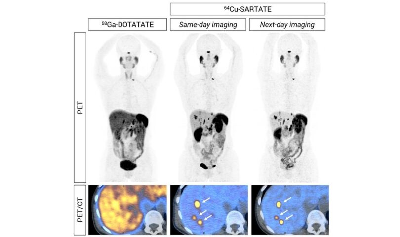 64Cu-SARTATE is highly effective in detecting tumours in NET patients compared to SOC imaging. Phase III planning underway.